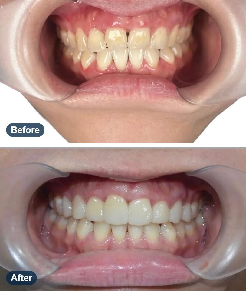 Veneers before and after: front teeth reshaped and brightened